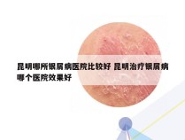 昆明哪所银屑病医院比较好 昆明治疗银屑病哪个医院效果好