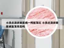 小孩点滴状银屑病一烤就发红 小孩点滴状银屑病复发率高吗