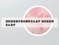 烫伤后皮肤引发白癜风怎么治疗 烫伤后白斑怎么治疗