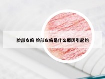 脸部皮癣 脸部皮癣是什么原因引起的