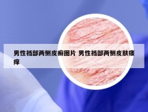 男性裆部两侧皮癣图片 男性裆部两侧皮肤瘙痒