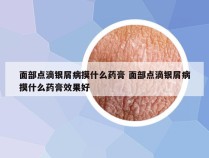 面部点滴银屑病摸什么药膏 面部点滴银屑病摸什么药膏效果好