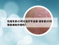 吃维生素d3可以治疗牛皮癣 维生素d3对银屑病有作用吗?