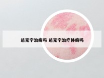 达克宁治癣吗 达克宁治疗体癣吗