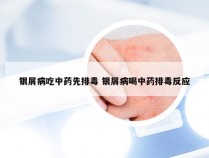 银屑病吃中药先排毒 银屑病喝中药排毒反应