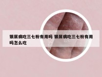 银屑病吃三七粉有用吗 银屑病吃三七粉有用吗怎么吃