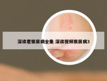 深读君银屑病全集 深读视频银屑病3