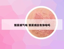 银屑病气味 银屑病会有体味吗