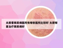 太原看银屑病医院有哪些医院比较好 太原哪里治疗银屑病好