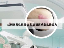 红斑继发性银屑病 红斑银屑病怎么治偏方