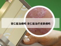 杏仁能治癣吗 杏仁能治疗皮肤病吗