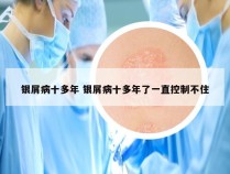 银屑病十多年 银屑病十多年了一直控制不住