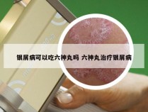 银屑病可以吃六神丸吗 六神丸治疗银屑病