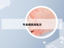 牛皮癣民间处方