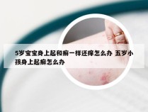 5岁宝宝身上起和癣一样还痒怎么办 五岁小孩身上起癣怎么办