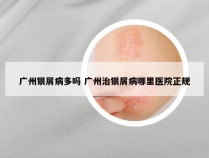 广州银屑病多吗 广州治银屑病哪里医院正规