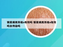 银屑病用异维a有效吗 银屑病用异维a有效吗会传染吗