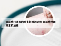 银屑病打激素的后多长时间见效 银屑病使用激素药加重