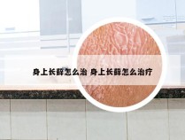 身上长藓怎么治 身上长藓怎么治疗