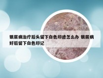 银屑病治疗后头留下白色印迹怎么办 银屑病好后留下白色印记