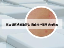 海口银屑病能治好么 海南治疗银屑病的地方