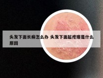 头发下面长癣怎么办 头发下面起疙瘩是什么原因