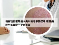 我有轻微银屑病大夫叫我吃甲氨蝶呤 银屑病吃甲氨蝶呤一个月无效