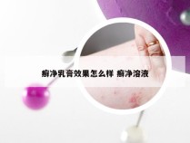 癣净乳膏效果怎么样 癣净溶液