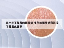 几十年不复发的银屑病 多年的银屑病突然没了是怎么回事