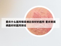 重庆什么医院银屑病比较好的医院 重庆银屑病最好的医院排名