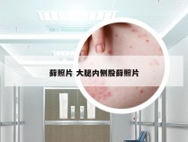 藓照片 大腿内侧股藓照片