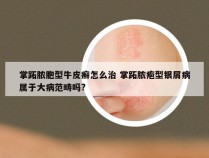 掌跖脓胞型牛皮癣怎么治 掌跖脓疱型银屑病属于大病范畴吗?