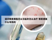 请问银屑病是怎么引起的怎么治疗 银屑病是什么导致的