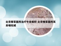 北京那家医院治疗牛皮癣好 北京哪家医院耳鼻喉权威