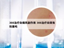 308治疗白癜风副作用 308治疗白斑有效果吗