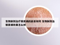 生物制剂治疗银屑病的前景如何 生物制剂治银屑病效果怎么样