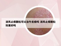 消风止痒颗粒可以治牛皮癣吗 消风止痒颗粒效果好吗