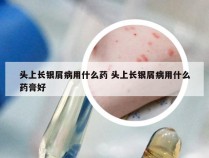 头上长银屑病用什么药 头上长银屑病用什么药膏好