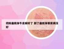 切除扁桃体牛皮癣好了 割了扁桃体银屑病没好