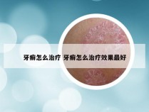 牙癣怎么治疗 牙癣怎么治疗效果最好