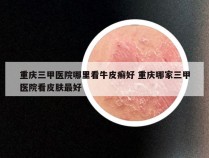 重庆三甲医院哪里看牛皮癣好 重庆哪家三甲医院看皮肤最好