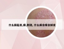 什么藓起皮,痒,刺挠, 什么癣会痒会掉皮