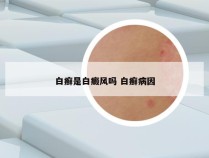 白癣是白癜风吗 白癣病因