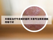 长春能治疗牛皮癣的医院 长春专治银屑病医院哪个好