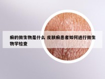 癣的微生物是什么 皮肤癣患者如何进行微生物学检查