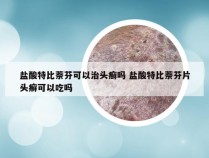 盐酸特比萘芬可以治头癣吗 盐酸特比萘芬片头癣可以吃吗