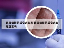 银屑病搽药后变大变黑 银屑病搽药后变大变黑正常吗