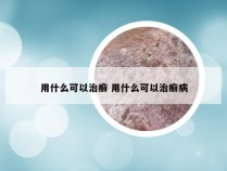 用什么可以治癣 用什么可以治癣病