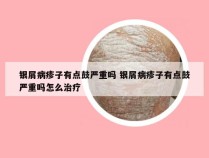 银屑病疹子有点鼓严重吗 银屑病疹子有点鼓严重吗怎么治疗