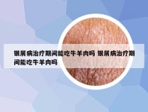 银屑病治疗期间能吃牛羊肉吗 银屑病治疗期间能吃牛羊肉吗